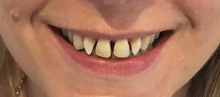 Before Invisalign Treatment Reading Smiles 