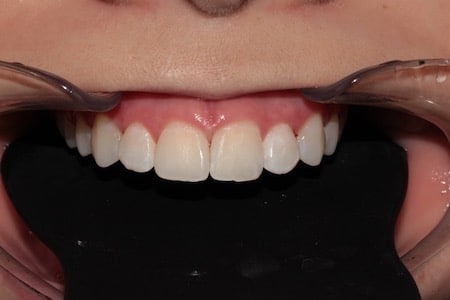 After Smile Makeover Treatment Smile Rooms 