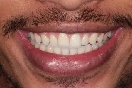 After Smile Makeover Treatment Smile Rooms 