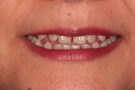 Before Smile Makeover Treatment Smile Rooms 