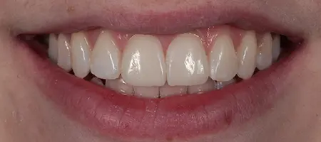 After Invisalign Treatment Reading Smiles 