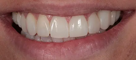 After Invisalign Treatment Reading Smiles 