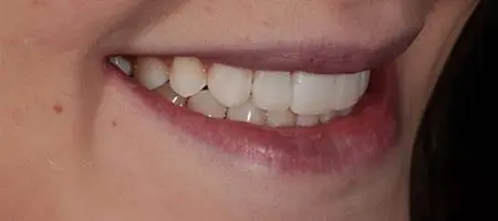 After Invisalign Treatment Reading Smiles 