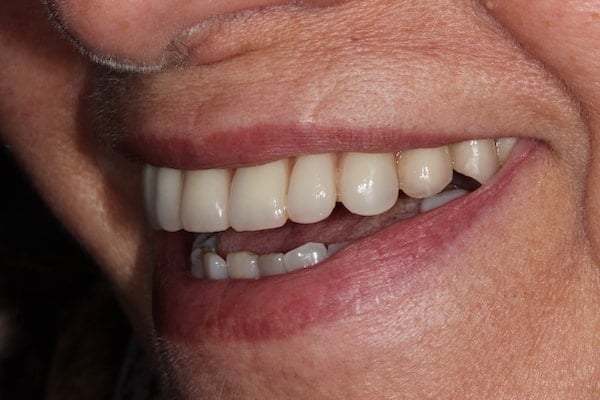 After Invisalign Treatment Reading Smiles 