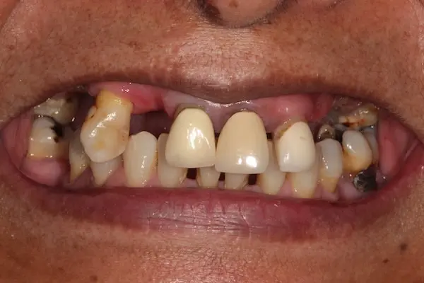 Before Invisalign Treatment Reading Smiles 