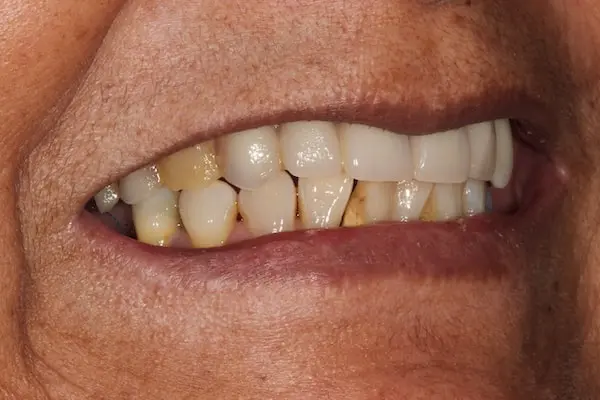 After Invisalign Treatment Reading Smiles 