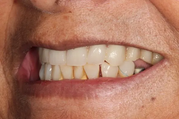 After Invisalign Treatment Reading Smiles 