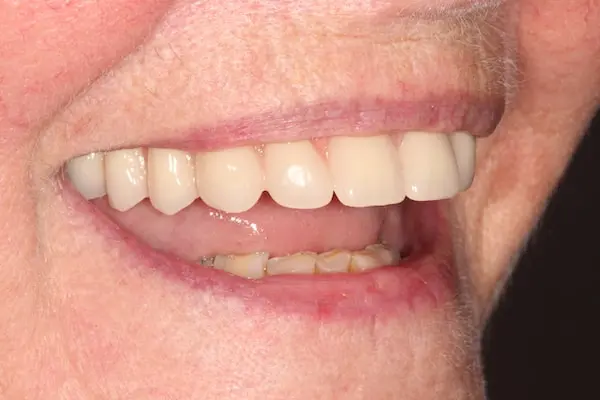 After Invisalign Treatment Reading Smiles 