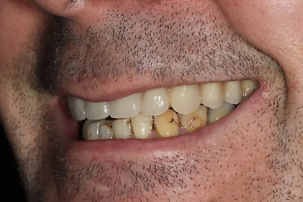 After Invisalign Treatment Reading Smiles 