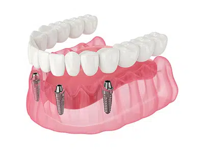 All on 4 dental implants Milton Keynes
