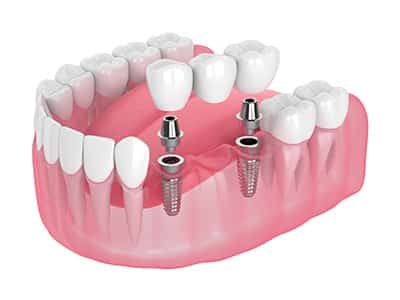 Dental implants Milton Keynes