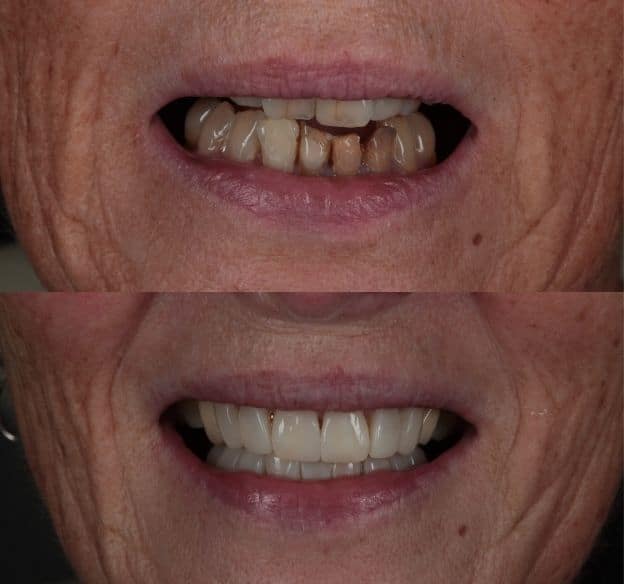 10composite-bonding-after-before