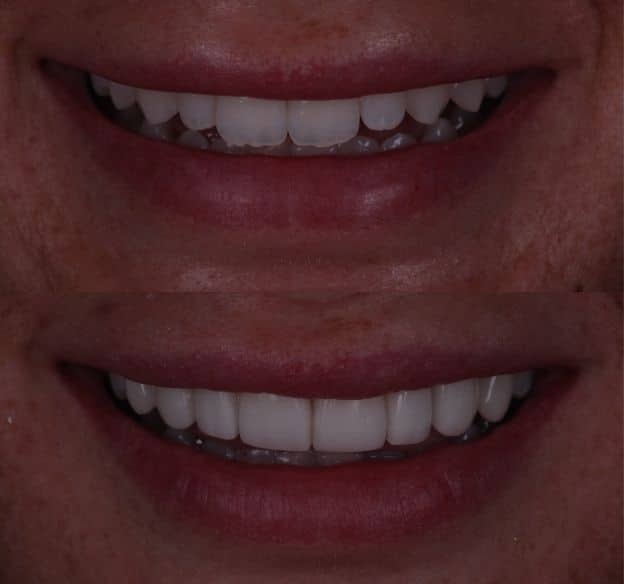 11composite-bonding-after-before