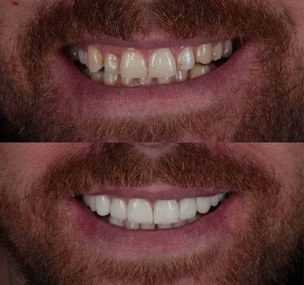 12composite-bonding-after-before