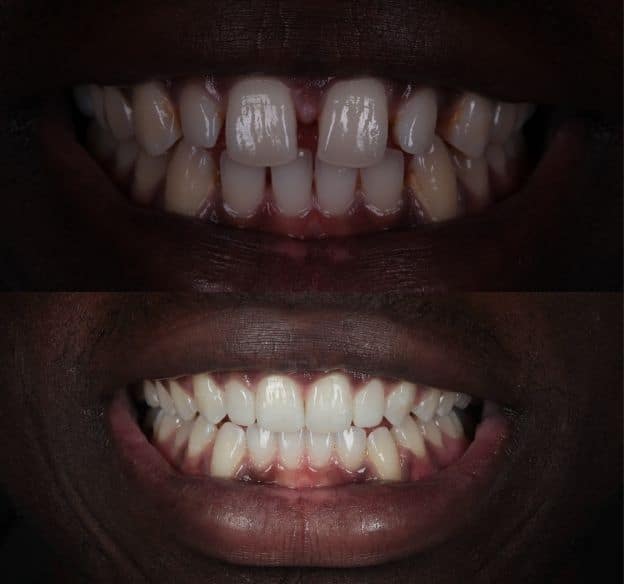13composite-bonding-after-before
