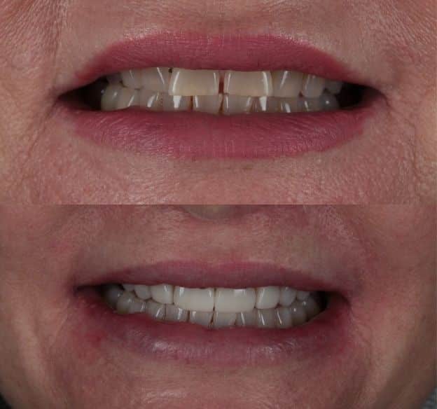 14composite-bonding-after-before