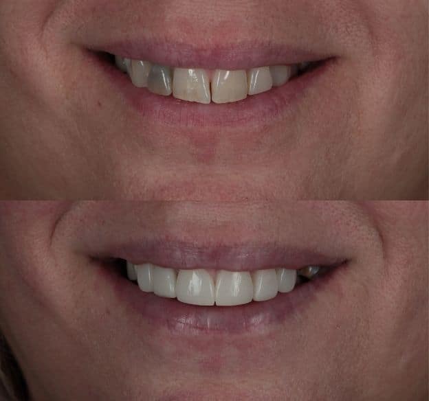 15composite-bonding-after-before