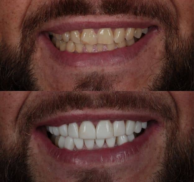 16composite-bonding-after-before