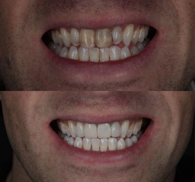 4composite-bonding-after-before
