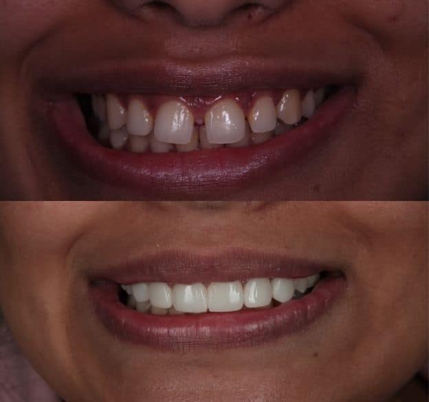 5composite-bonding-after-before
