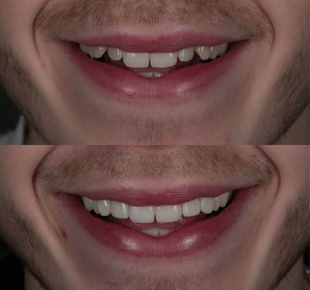 6composite-bonding-after-before