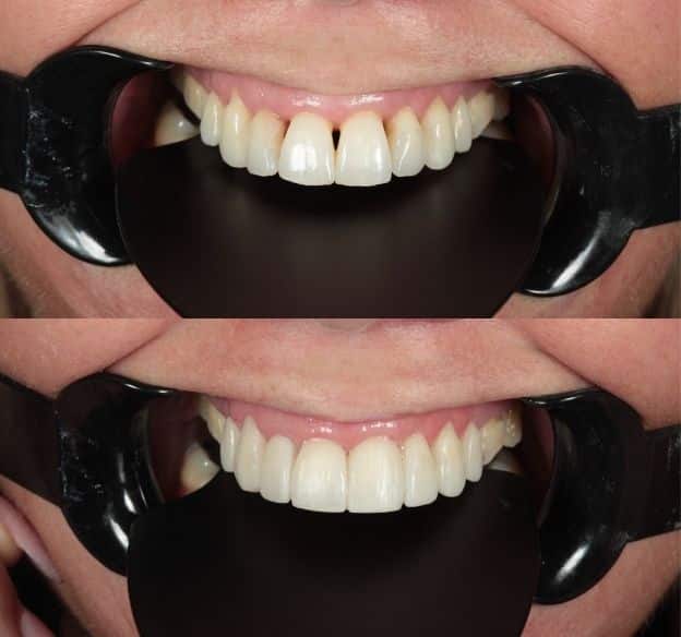 7composite-bonding-after-before