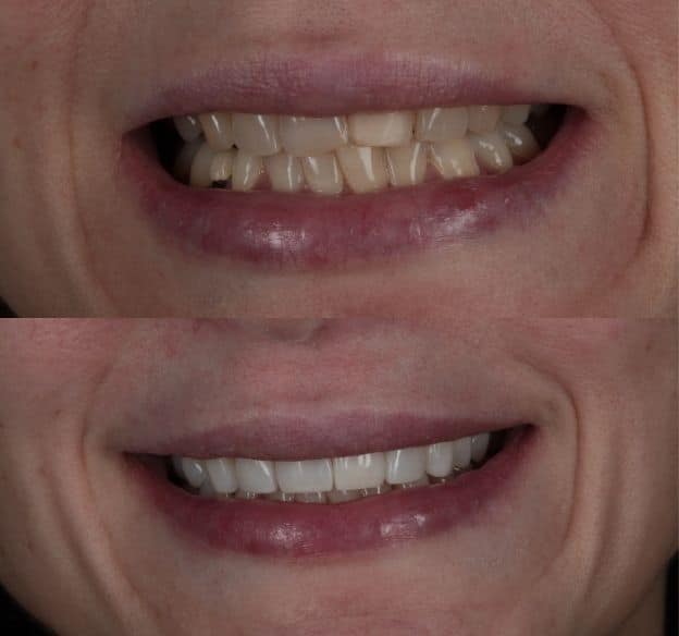 8composite-bonding-after-before