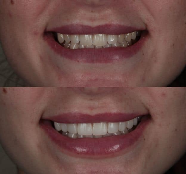 9composite-bonding-after-before