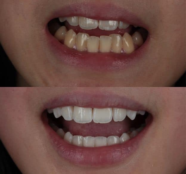invisalign-after-and-before