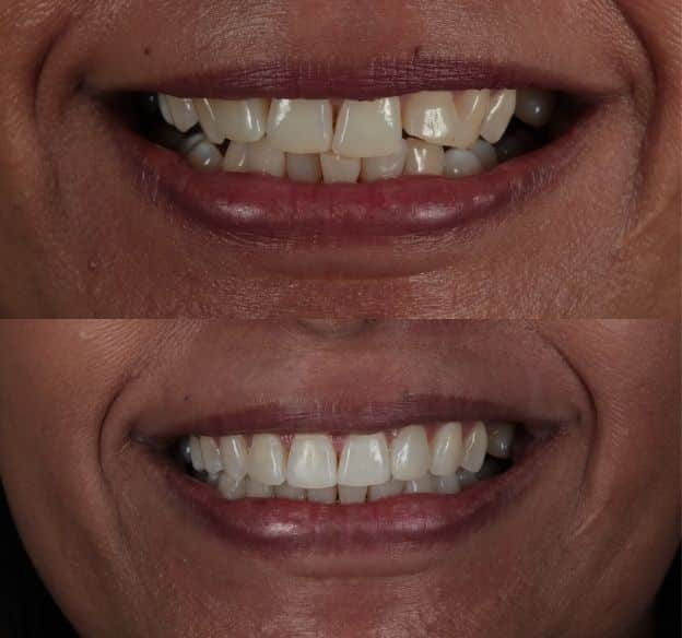invisalign-before-after-case