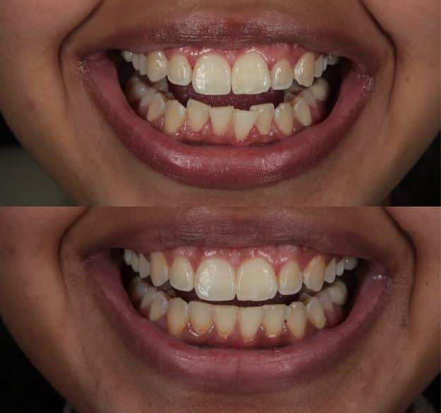 invisalign-before-after