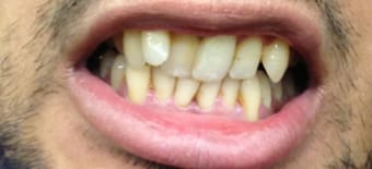 Before and After Invisalign Treatment Wokingham