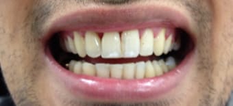 Before and After Invisalign Treatment Wokingham