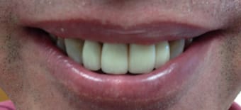 Before and After Invisalign Treatment Wokingham