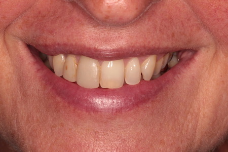 Before and After Invisalign Treatment Wokingham