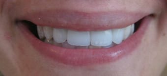 Before and After Invisalign Treatment Wokingham