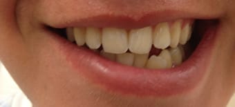 Before and After Invisalign Treatment Wokingham