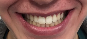 Before and After Invisalign Treatment Wokingham