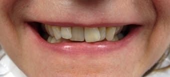 Before and After Invisalign Treatment Wokingham
