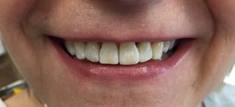 Before and After Invisalign Treatment Wokingham