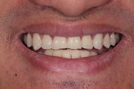 Before and After Invisalign Treatment Wokingham