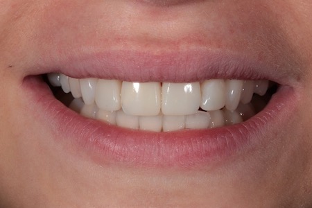 Before and After Invisalign Treatment Wokingham