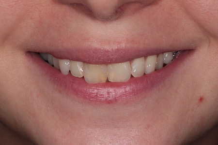 Before and After Invisalign Treatment Wokingham