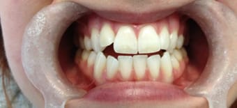 Before and After Invisalign Treatment Wokingham