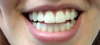 Before and After Invisalign Treatment Wokingham