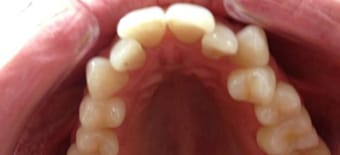 Before and After Invisalign Treatment Wokingham