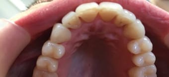 Before and After Invisalign Treatment Wokingham