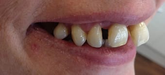 Before and After Invisalign Treatment Wokingham