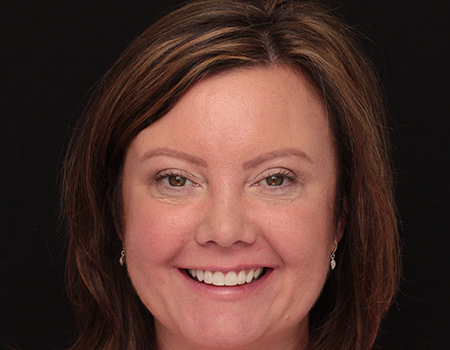 Before and After Bonding Treatment Wokingham