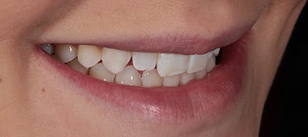 Before and After Bonding Treatment Wokingham